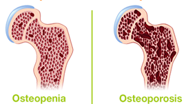 OSTEOPOROSE E OSTEOPENIA